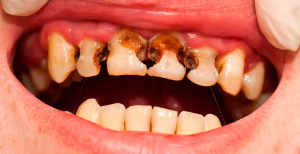 Влияние курения на зубы и ротовую полость